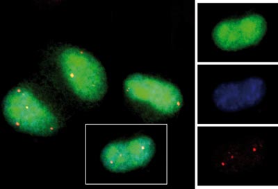 Záchrana buněk exprimujících mutovaný hPrp31 (zelený) pomocí hPrp6 (modrý). Červeně jsou označena nově vzniklá Cajalova tělíska, která indikují zlepšenou formu buněk obsahujících hPrp6.